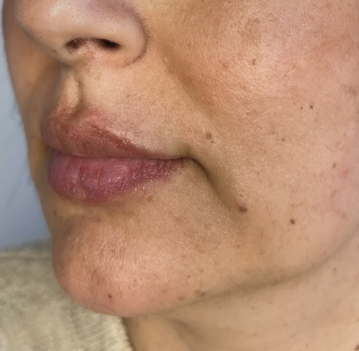 Før og efter resultat af læbefiller behandling, sæt to, billede et