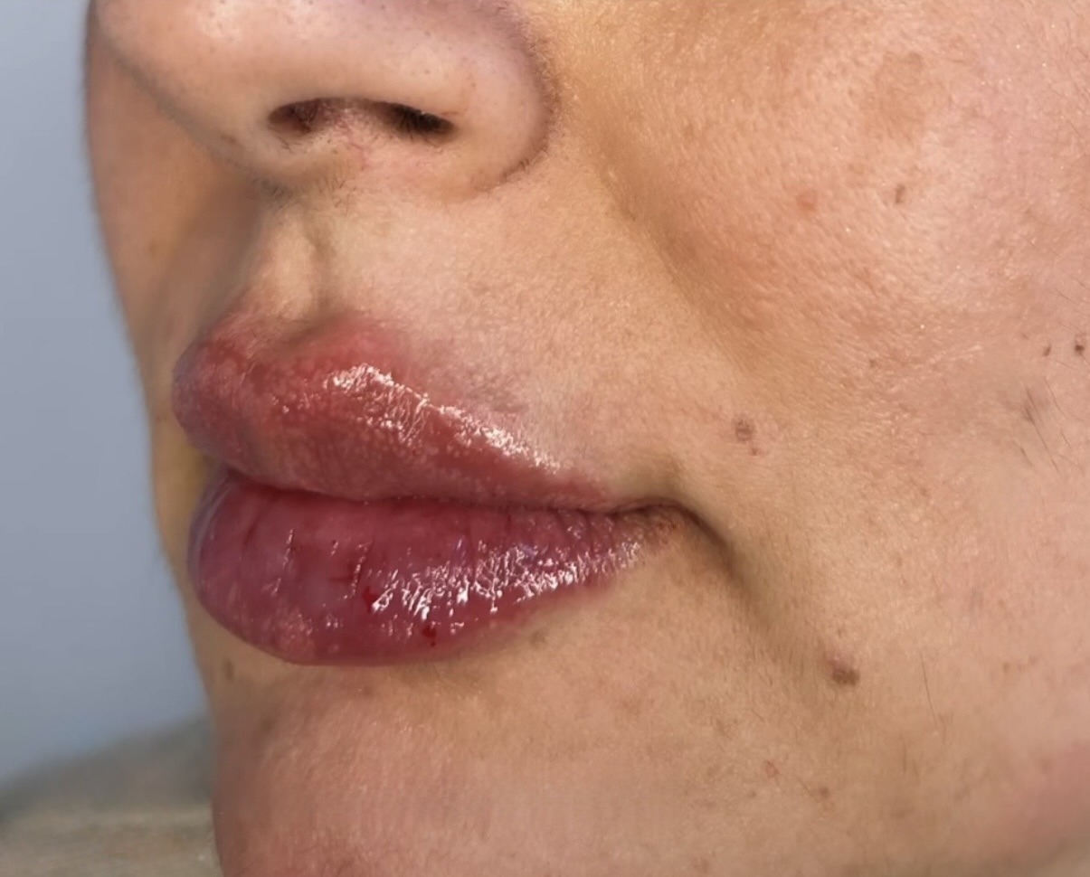 Før og efter resultat af læbefiller behandling, sæt to, billede to